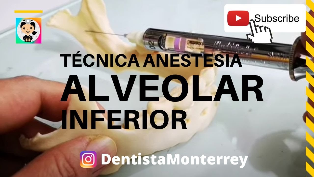💉TÉCNICA ANESTESIA ALVEOLAR INFERIOR👅 PASO A PASO