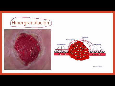 Vídeo: Diferencia Entre Epitelización Y Granulación