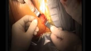 Lesione Cartilaginea del ginocchio(Trattamento di una lesione cartilaginea del ginocchio di IV grado del condilo femorale interno con microfratture, cellule staminali su membrana e fattori di ..., 2013-05-28T23:25:40.000Z)