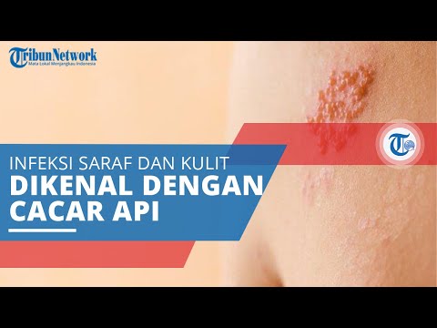 Herpes Zoster, Infeksi pada Saraf dan Kulit di Sekitarnya yang Sering Disebut dengan Cacar Api