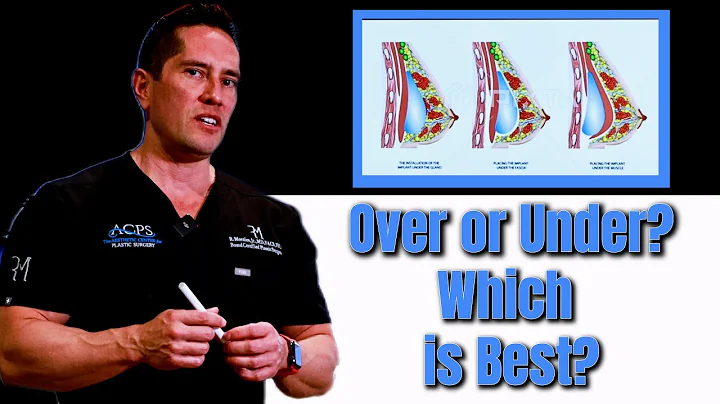 Breast Implants: Over or Under, Which is Best?