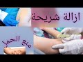 ازالة شريحة منع الحمل الكبسولة باسهل طريقة 