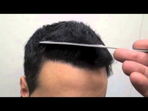 Fue Result 1768 Grafts Dr Rahal You