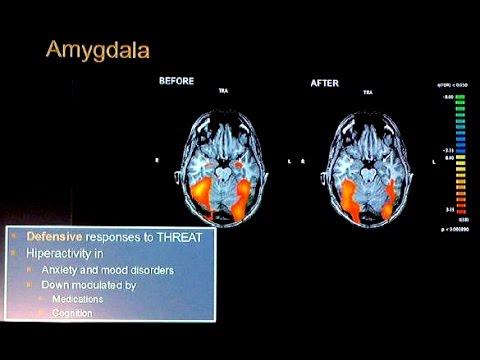 Fmri Study On Ayahuasca Effects On The Brain Prof Tiago Arruda Sanchez Youtube
