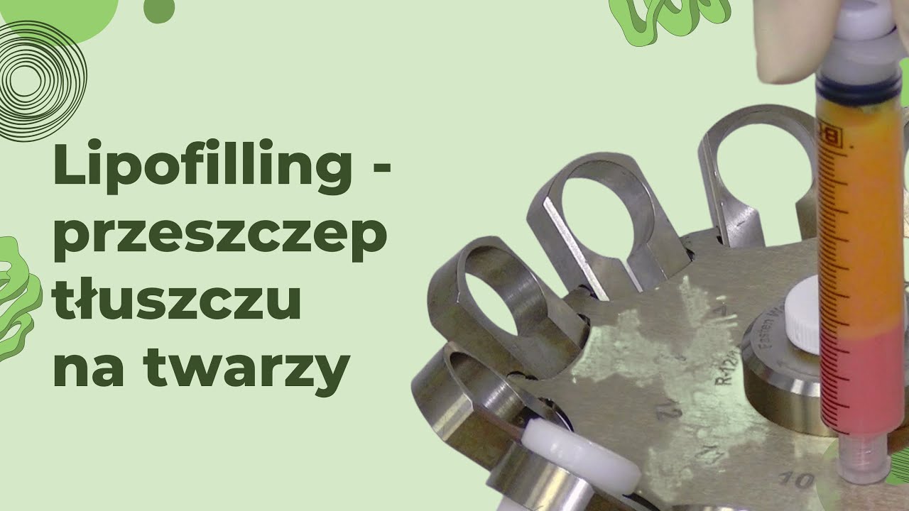 Lipofilling - przeszczep tłuszczu na twarzy (prezentacja i omówienie zabiegu)