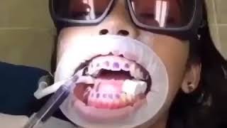 Colocación de Brackets