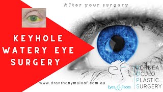 After your surgery - Keyhole Watery Eye Surgery - Dr Anthony Maloof Sydney Australia Faq Will My Tear Drain Tube Fall Out Dr Anthony Maloof Sydney