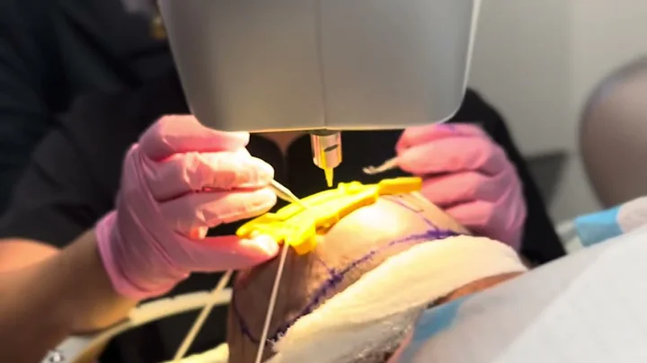 Hair Transplant at Salt Spa & Wellness Center in Virginia Beach