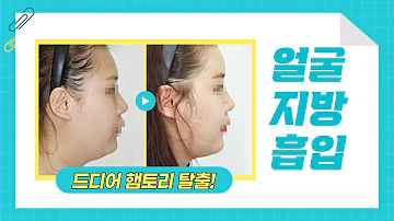 볼살 턱살 간단하게 얼굴살빼기｜얼굴지방흡입 하기 전 꼭 봐야할 영상 | CASE.03 | 메이트성형외과