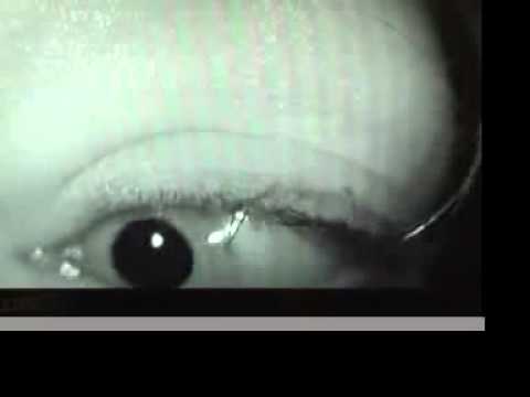Right Posterior Canal Canalithiasis - YouTube
