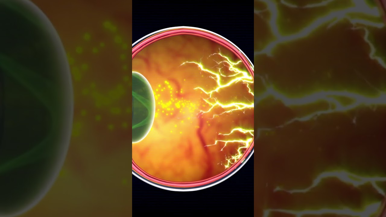 What Is Diabetic Retinopathy? | Diabetic Eye Disease Explained