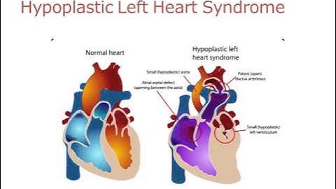 What is a Fontan Repair?