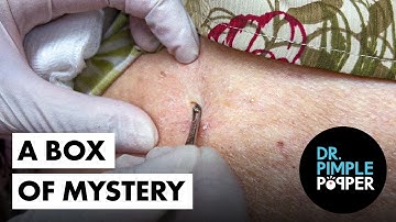 Dr. Pimple Popper Opens a Box of Mystery Pops