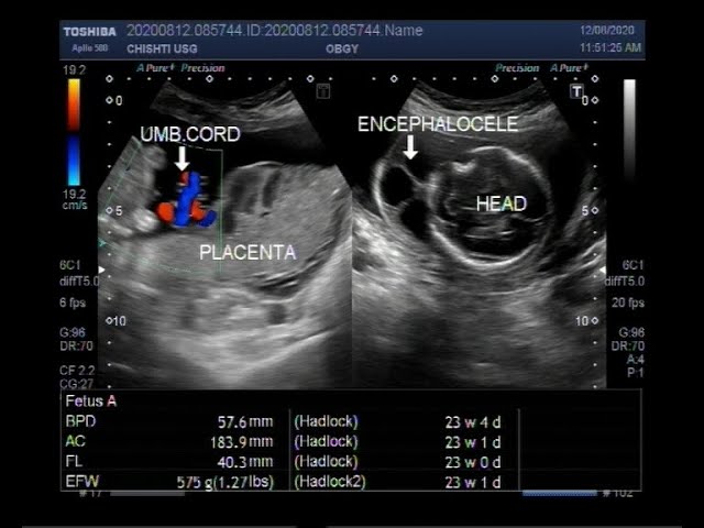 Ultrasound Video Showing Fetal Anomalies Clubfoot Encephalocele Kyphosis And Placental Mass Youtube