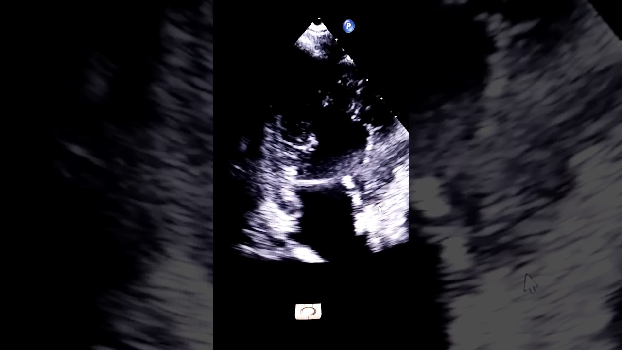 Жидкость в перикарде