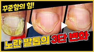 병아리처럼 샛~노란 내 발톱, 예쁜 분홍빛의 건강한 발톱으로 재탄생했어요! / athlete&#39;s foot