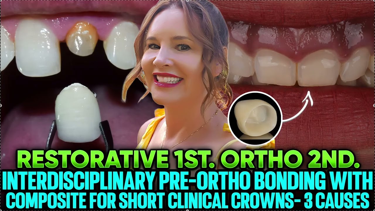 Три причины коротких клинических коронок - концепция Роббинса - предортодонтическое приклеивание