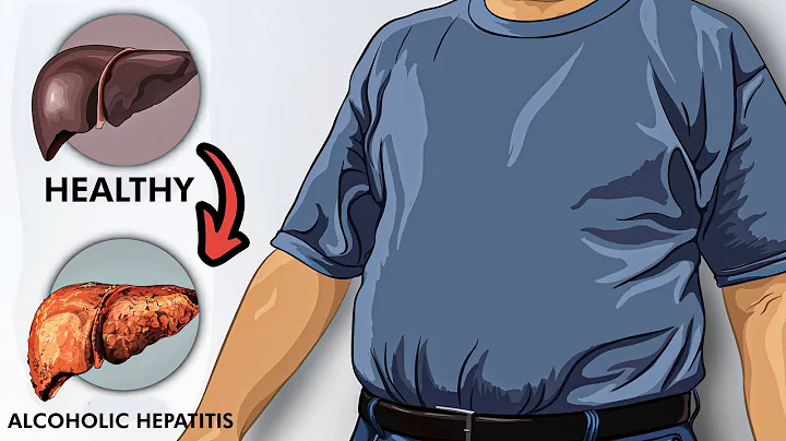 Alcoholic Hepatitis: Pathophysiology, Signs and Symptoms, Diagnosis and Treatment