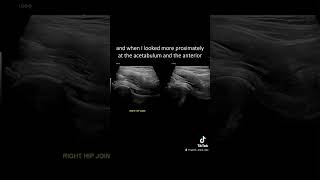 Ultrasound Guided Interventions: Cases (Anterior Hip Pain) #ultrasound
