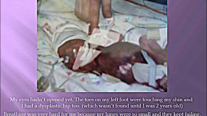 Baby Emma born at 24 weeks