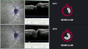 SPECTRALIS OCT vs OCT2 Module: Glaucoma Module Premium Edition