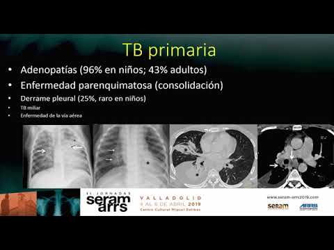 Vídeo: Nomograma Predictivo Basado En Tomografía Computarizada Para Diferenciar La Tuberculosis Pulmonar Progresiva Primaria De La Neumonía Adquirida En La Comunidad En Niños