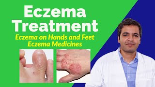 Eczema (Atopic Dermatitis): Causes, Treatment, Prevention and Home Remedies