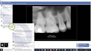 Training: Apteryx XVWeb - Editing Tooth Association on a Single Image in XVCapture