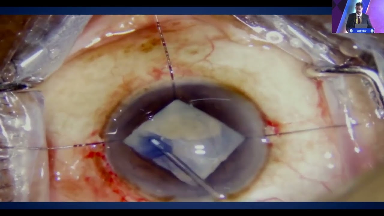 AIOC2022 IC46 Topic Dr  MINU M  MATHEN  SICS IN SMALL PUPIL EYES