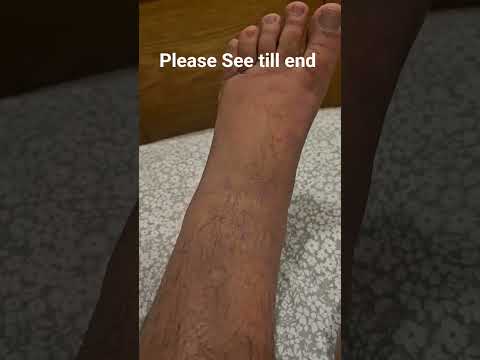CRPS syndrome