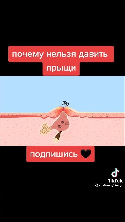 Почему нельзя выдавливать прыщи #shorts - YouTube