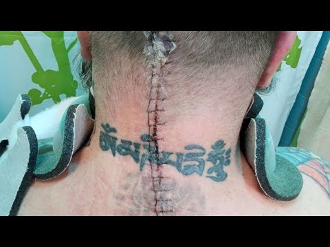 So I Did A Thing - One Month Post Op C1-C7 Total Fusion Update