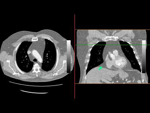 ቪዲዮ: Extrapleural fat ምንድን ነው?