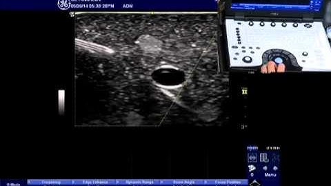 NextGen LOGIQ e: Needle Recognition