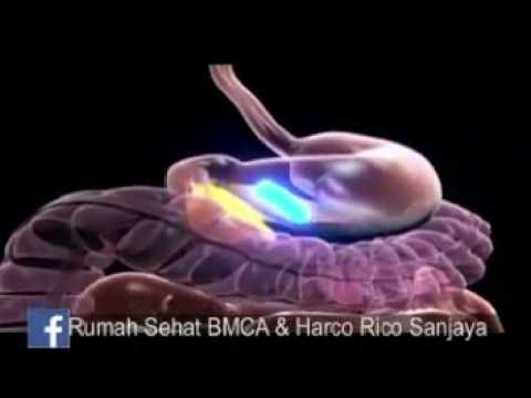 Kencing Manis: Gejala, Ciri, Penyebab, Obat dan Ramuan Tradisionalnya