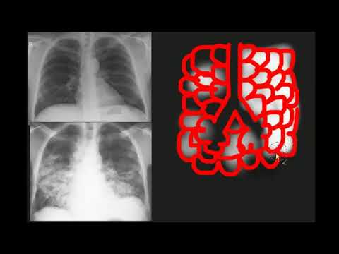 Vídeo: O que é uma opacidade pulmonar?