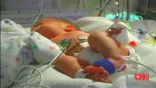 Woman With 2 Wombs Gives Birth To 2 ! | Double Dose of Uterus