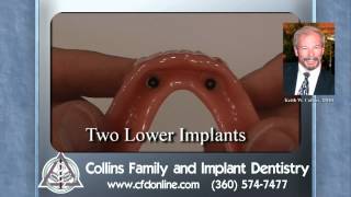 Two lower implants to anchor a denture