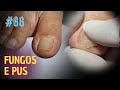 FUNGO E PUS (PUS AND FUNGI) - PODÓLOGO MAURÉLIO