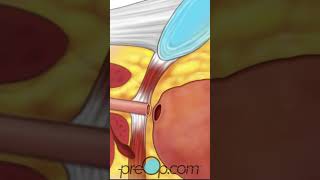 Laparoscopic Radical Prostatectomy - PreOp® Patient Education & Patient Engagement shorts