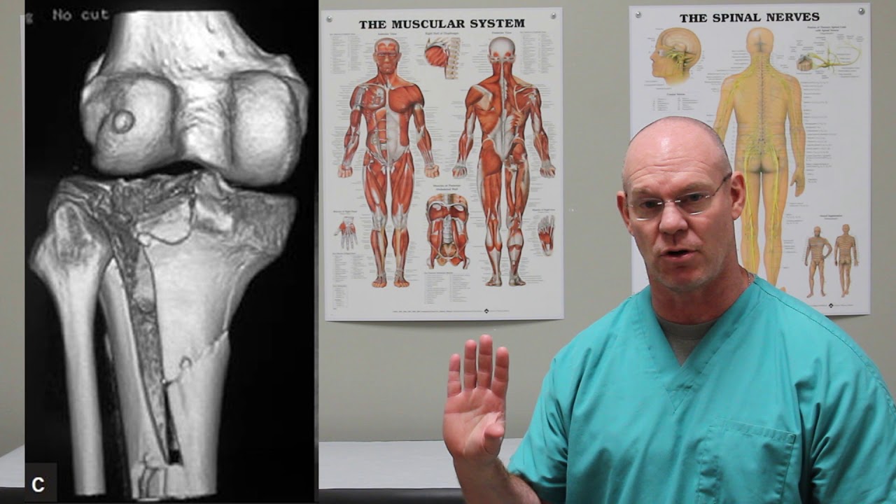 Tibial Plateau Fractures Fracture Friday Episode 27 YouTube