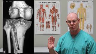 Tibial Plateau Fractures | Fracture Friday Episode 27