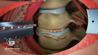 شاهد عملية ازالة الغضروف _ lumbar discectomy screenshot 1