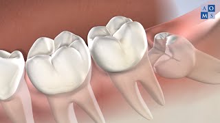 Wisdom Teeth Removal in Amarillo, TX | Amarillo Oral & Maxillofacial Surgery