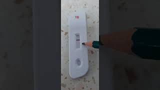 Tuberculosis (TB) test for detection of Mycobacterium tuberculosis antibody shows negative reaction.