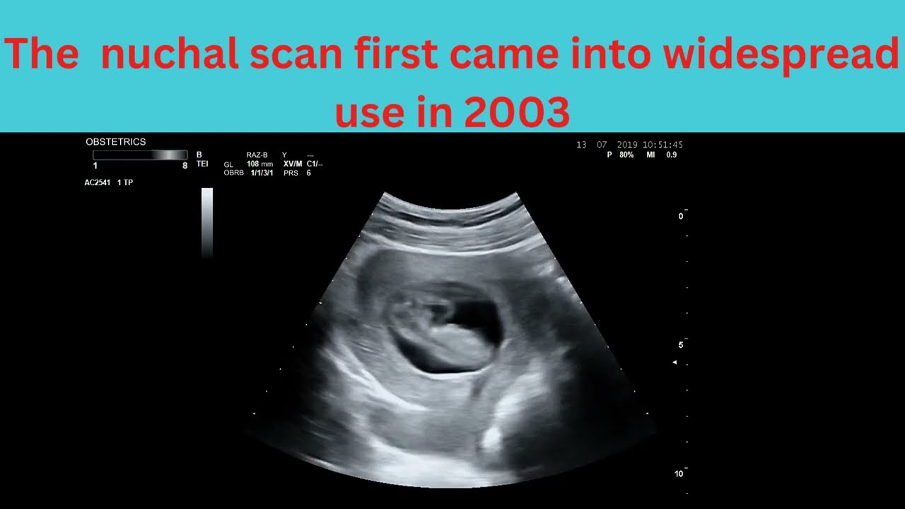 NT Scan - Nuchal Translucency Scan | pregnancy First trimester