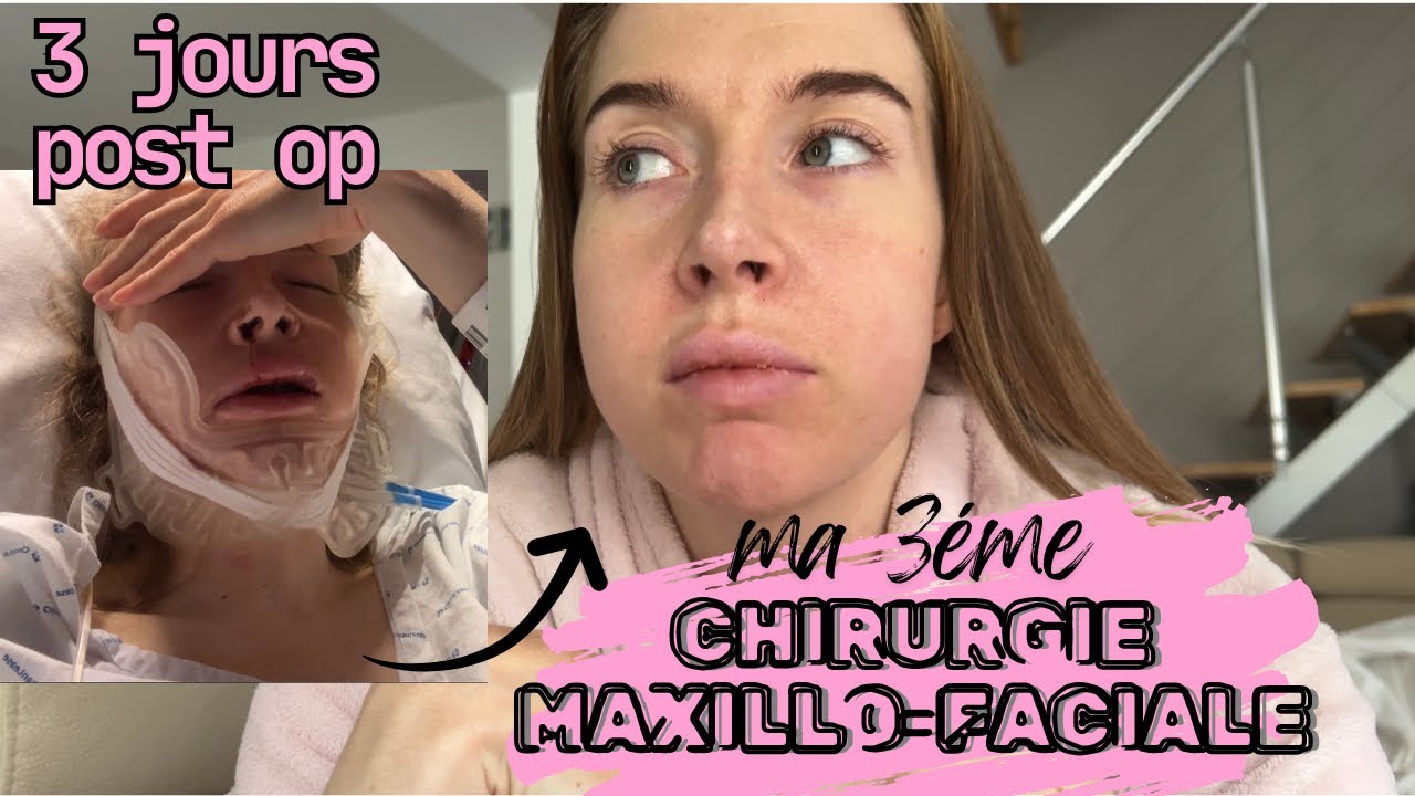 Chirurgie Maxillo-faciale / 3 jours POST-OP ! Retour sur ma 3éme ...
