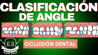 Clasificación De Las Maloclusiones Clasificación De Angle Oclusión Dental.