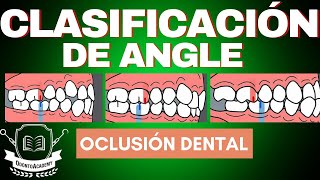 CLASIFICACIÓN DE LAS MALOCLUSIONES | CLASIFICACIÓN DE ANGLE | oclusión dental.