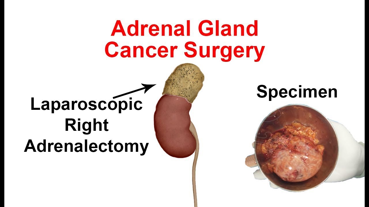 Removal of adrenal glands - jafeducation